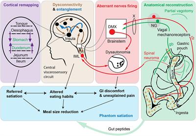 The Phantom Satiation Hypothesis of Bariatric Surgery